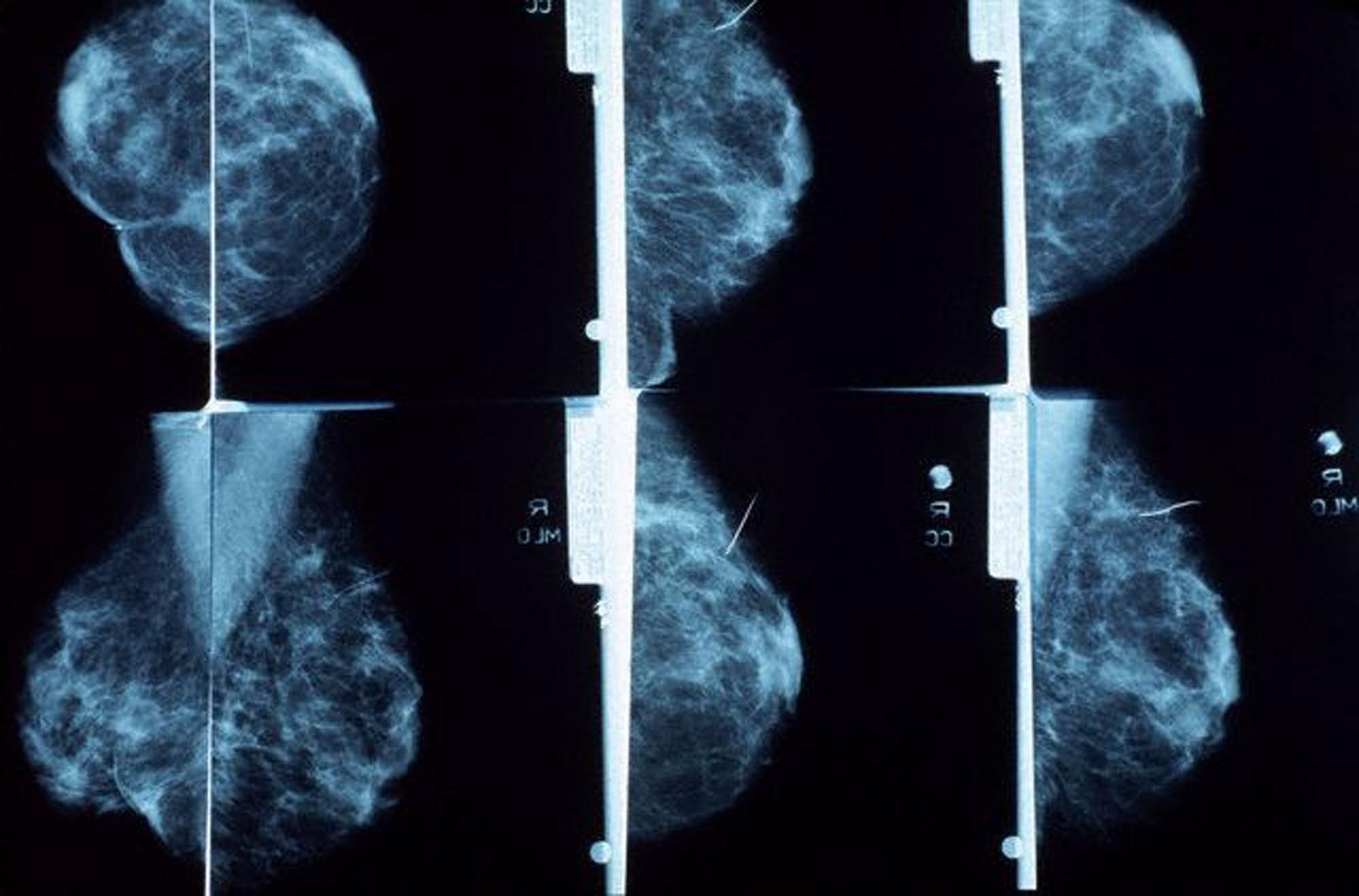 Harán mamografías en Los Nuevos Teques