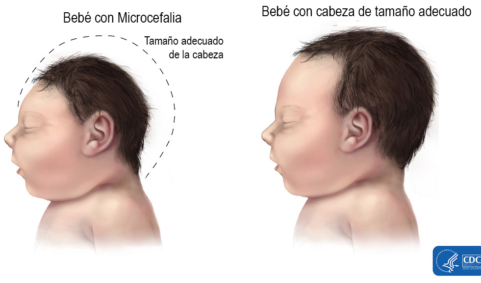 Conoce la microcefalia, vinculada al Zika