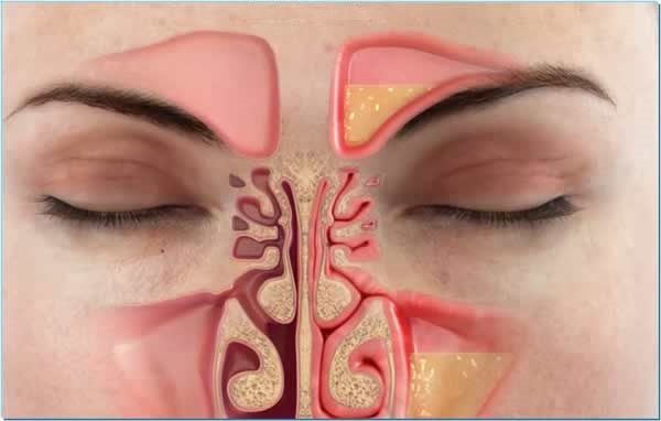 6 remedios caseros para combatir la sinusitis