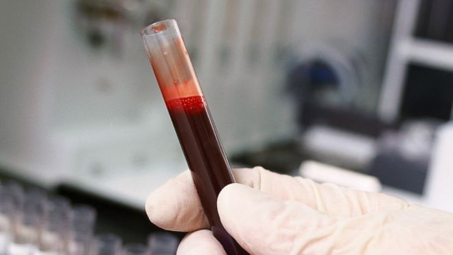 Crean técnica para detectar autismo a partir de un examen de sangre