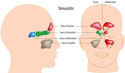 Cómo tratar la sinusitis naturalmente