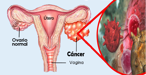 Cáncer de ovario: Un asesino silencioso