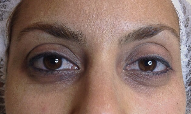 Técnicas para evitar las ojeras
