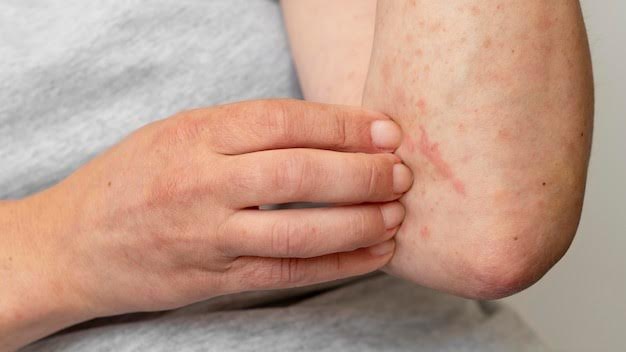 <strong>La dermatitis atópica afecta la calidad de vida</strong>