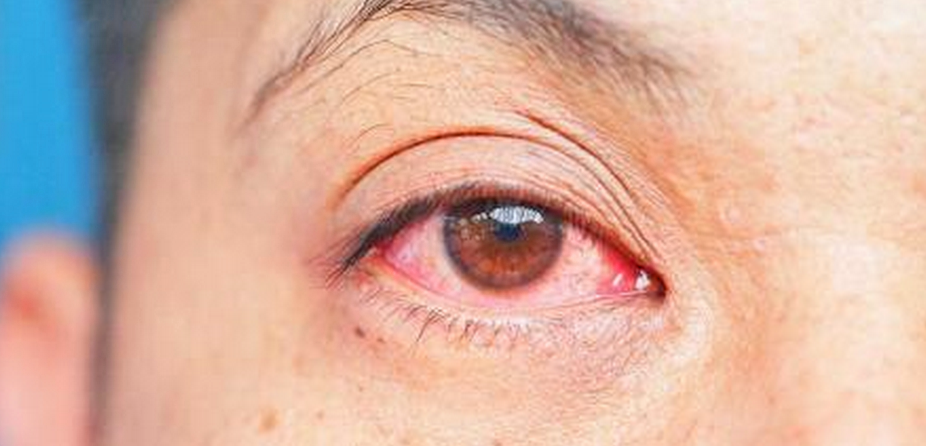 “La manzanilla no sirve para curar la conjuntivitis”
