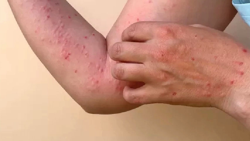 Panamá acumula 26 casos de viruela símica