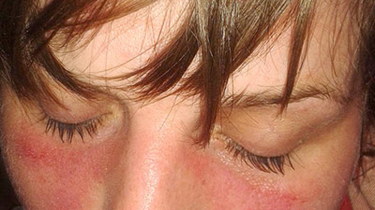 <strong>El lupus puede provocar daños en la piel, riñones y en el cerebro</strong>