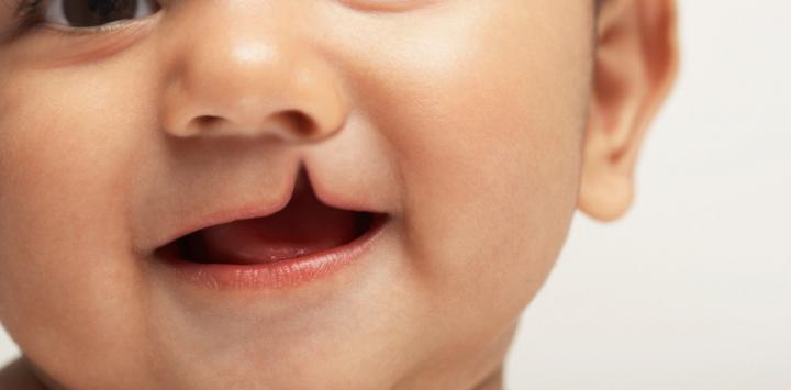 Hospital Domingo Luciani celebra la I jornada de cirugía buco-maxilofacial pediátrica