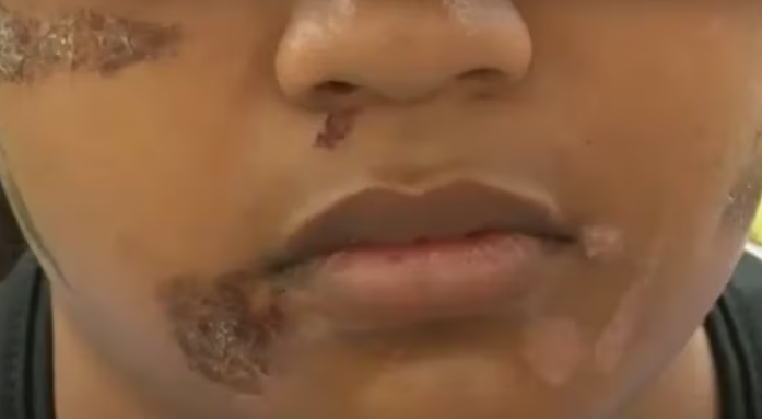 Estudiante venezolana de 15 años sufre quemaduras en la cara en Perú