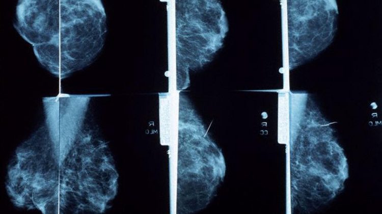 01-Estudio-mamografía