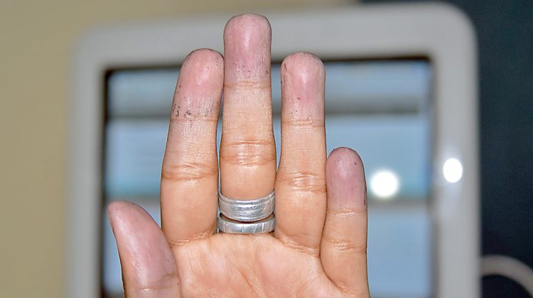 Cianosis