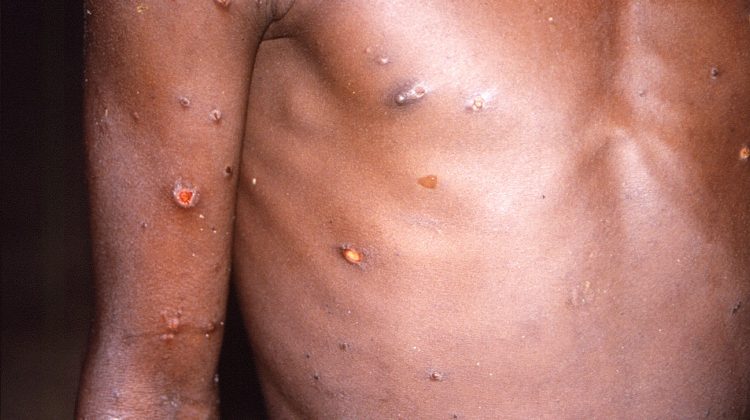 FILE PHOTO: An image created during an investigation into an outbreak of monkeypox, which took place in the Democratic Republic of the Congo, 1996 to 1997, shows the arms and torso of a patient with skin lesions due to monkeypox, in this undated image obtained by Reuters on May 18, 2022. CDC/Brian W.J. Mahy/Handout via REUTERS THIS IMAGE HAS BEEN SUPPLIED BY A THIRD PARTY./File Photo