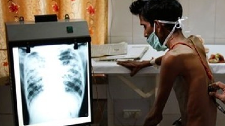 La tuberculosis es causante de una grave desnutrición