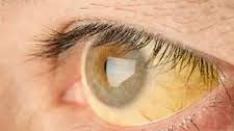 Los ojos amarillos son indicativos de la enfermedad