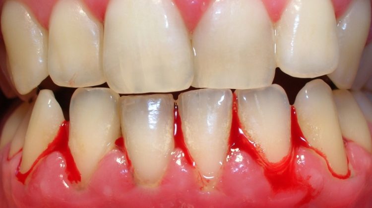 Recomiendan asistir regularmente al dentista y limpiar de manera adecuada los dientes