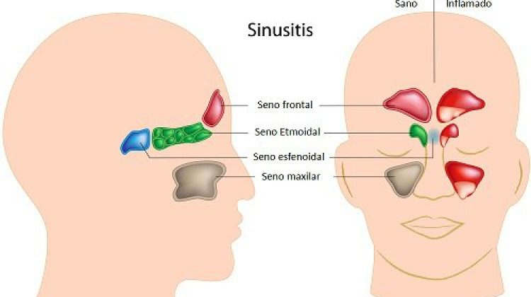 Sinusitis-500x291