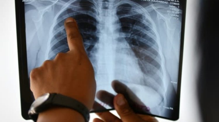 Tuberculosis