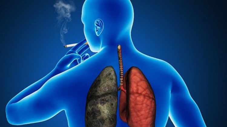 cancer-pulmon