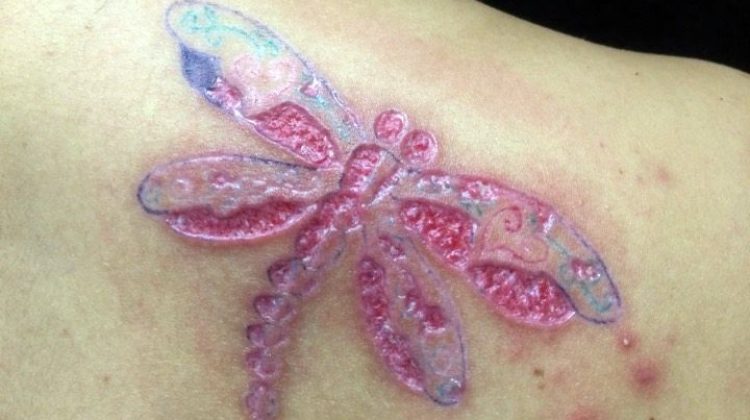 complicaciones con tatuajes1