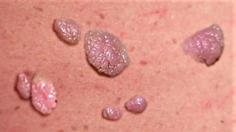 el-virus-afecta-a-gran-parte-de-la-poblacion
