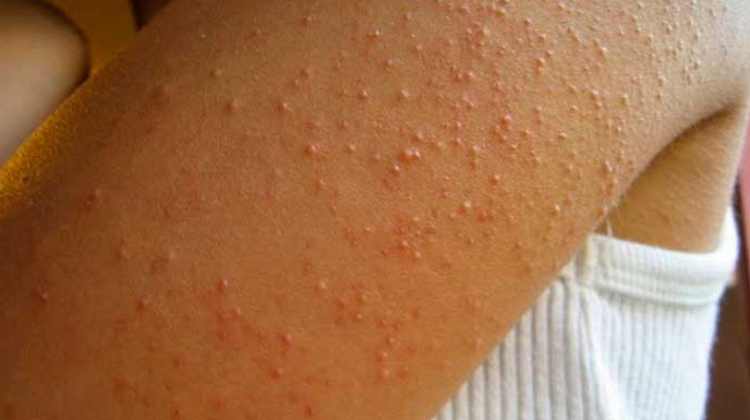 enfermedades en la piel