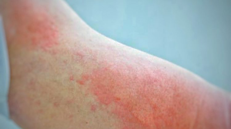 urticaria